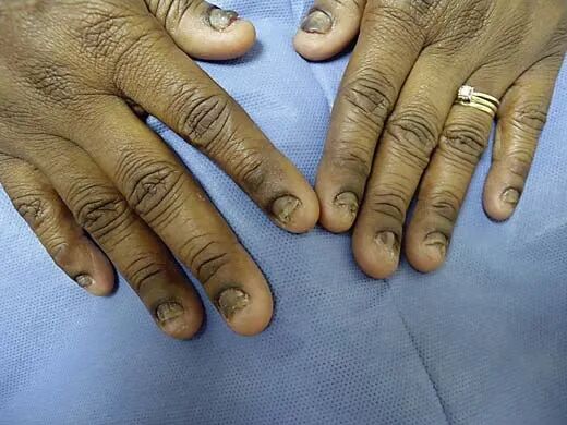 牙科光固化机是什么光患者齿科术后突发过敏，竟是美甲惹的祸？！_https://www.jmylbn.com_新闻资讯_第6张