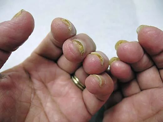 牙科光固化机是什么光患者齿科术后突发过敏，竟是美甲惹的祸？！_https://www.jmylbn.com_新闻资讯_第7张