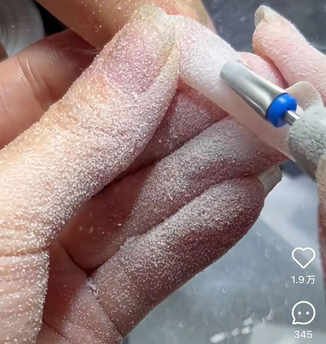 牙科光固化机是什么光患者齿科术后突发过敏，竟是美甲惹的祸？！_https://www.jmylbn.com_新闻资讯_第2张