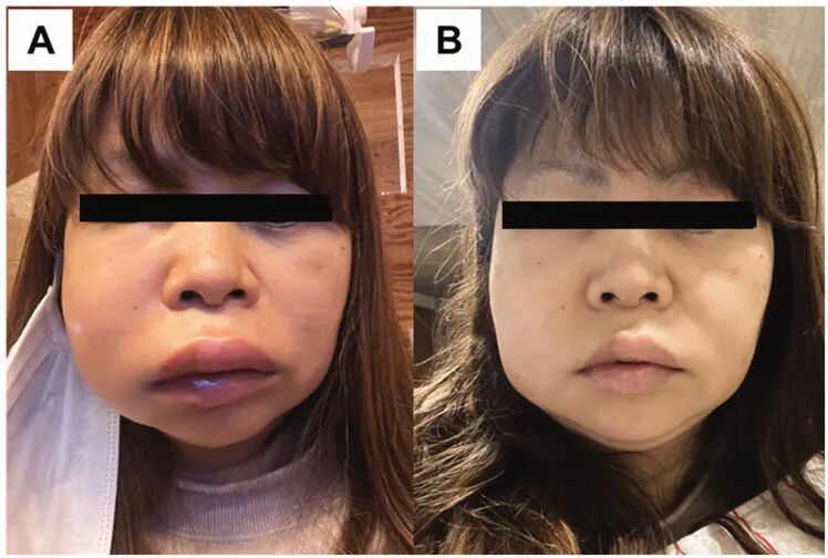 牙科光固化机是什么光患者齿科术后突发过敏，竟是美甲惹的祸？！_https://www.jmylbn.com_新闻资讯_第9张