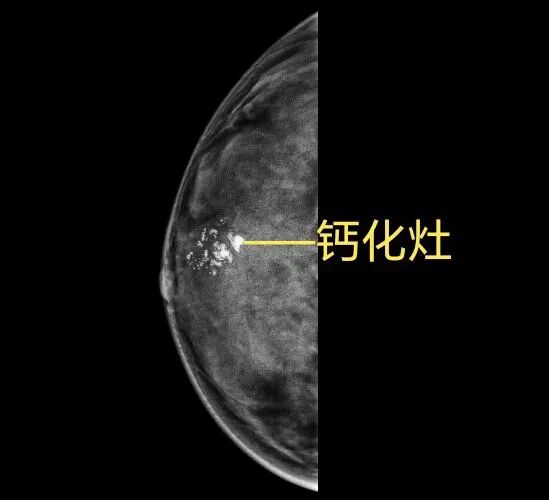 乳腺机为什么叫钼靶照完乳腺B超，为什么还要照钼靶？_https://www.jmylbn.com_新闻资讯_第7张