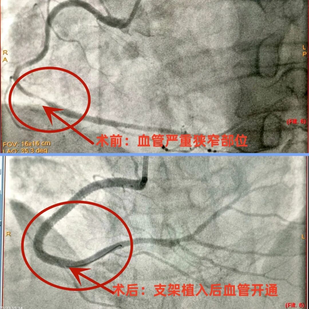 主动脉硬化怎样治疗