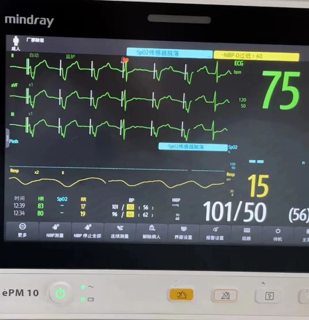 床旁x怎么使用含山县人民医院成功独立完成首例床旁经颈静脉漂浮电极心脏临时起搏器植入术！_https://www.jmylbn.com_新闻资讯_第8张