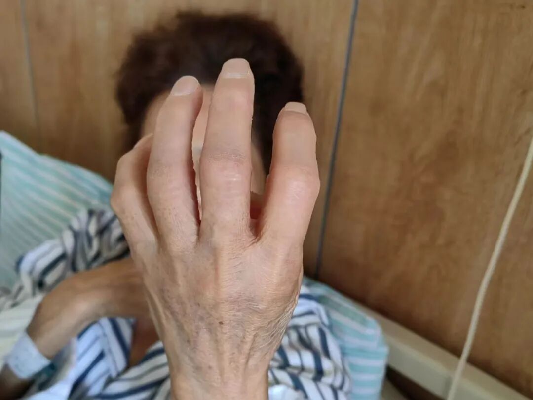 手电极怎么用手指一动就疼？金医疼痛病房用一根1.4毫米的电极解决顽固性神经痛_https://www.jmylbn.com_新闻资讯_第3张