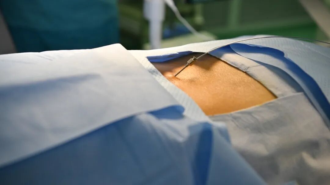 手电极怎么用手指一动就疼？金医疼痛病房用一根1.4毫米的电极解决顽固性神经痛_https://www.jmylbn.com_新闻资讯_第6张