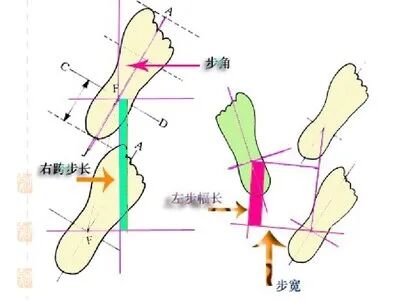 步态分析上曲线怎么解读康复科普｜常见异常步态的介绍及测试_https://www.jmylbn.com_新闻资讯_第5张