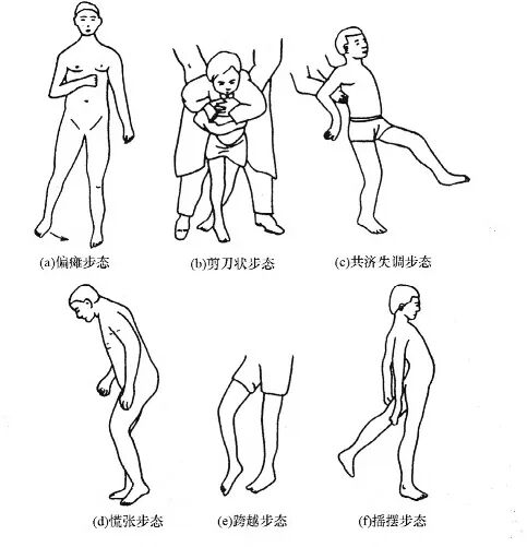 步态分析上曲线怎么解读康复科普｜常见异常步态的介绍及测试_https://www.jmylbn.com_新闻资讯_第11张