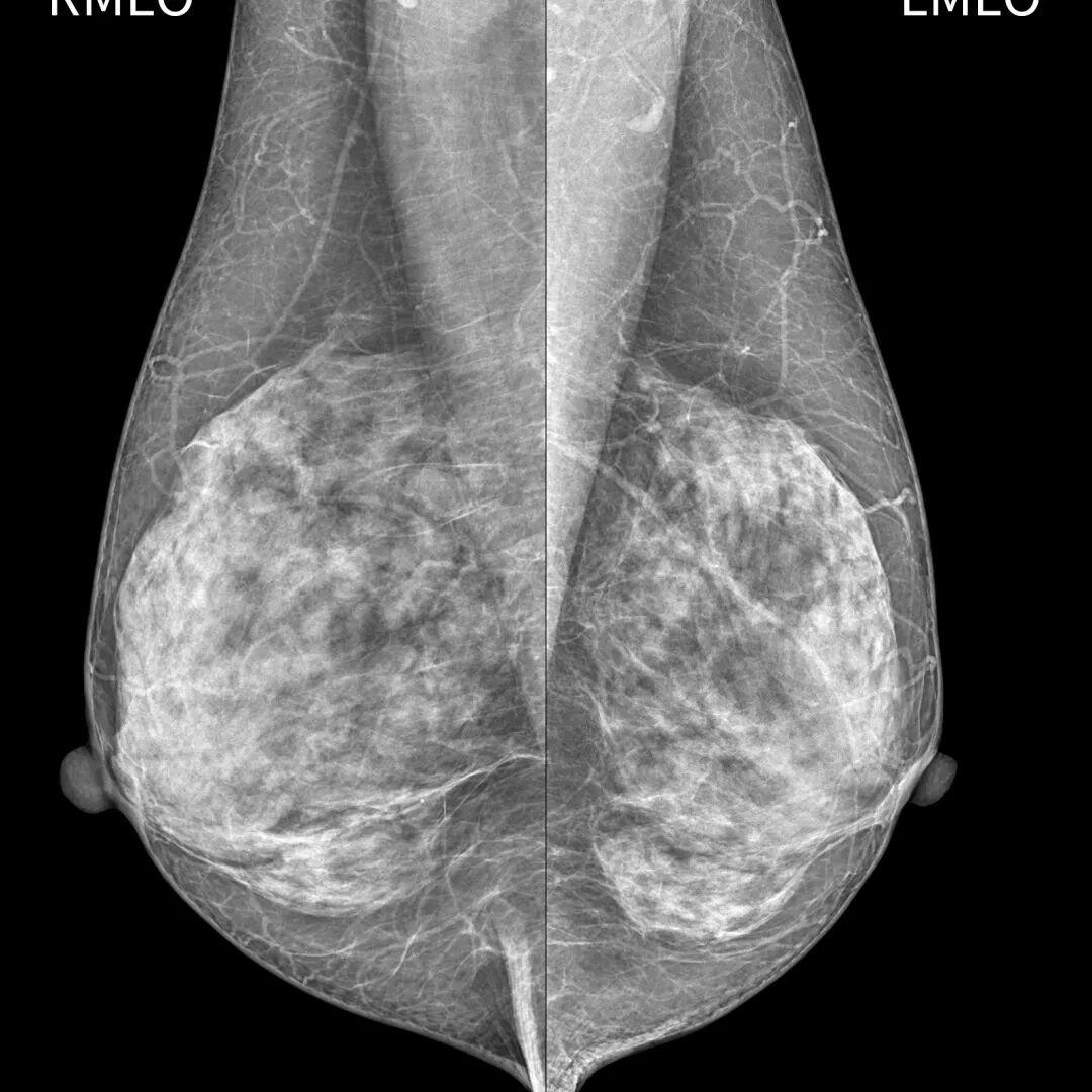 数字化乳腺摄影是什么【关注乳腺健康 期待美好未来】我院引进的新设备已投入使用！——数字化乳腺钼靶摄影机_https://www.jmylbn.com_新闻资讯_第9张