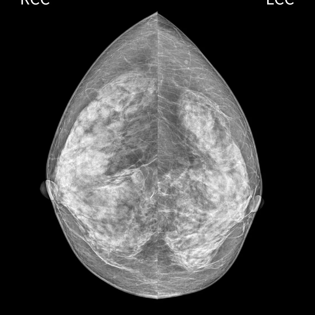 数字化乳腺摄影是什么【关注乳腺健康 期待美好未来】我院引进的新设备已投入使用！——数字化乳腺钼靶摄影机_https://www.jmylbn.com_新闻资讯_第8张