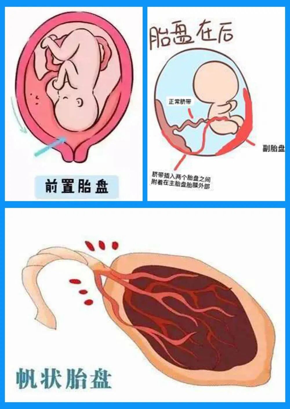 md是胎儿的什么胎儿杀手之前置胎盘并前置血管-上海聚慕医疗器械有限公司