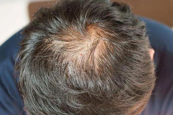 脂溢性脱发的症状表现有哪些