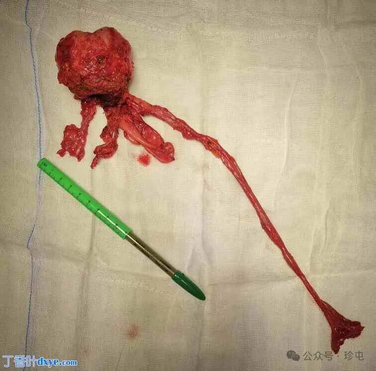 前列腺机器怎么治疗机器人辅助根治性前列腺切除术治疗 Zinner 综合征患者_https://www.jmylbn.com_新闻资讯_第1张