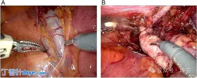前列腺机器怎么治疗机器人辅助根治性前列腺切除术治疗 Zinner 综合征患者_https://www.jmylbn.com_新闻资讯_第2张