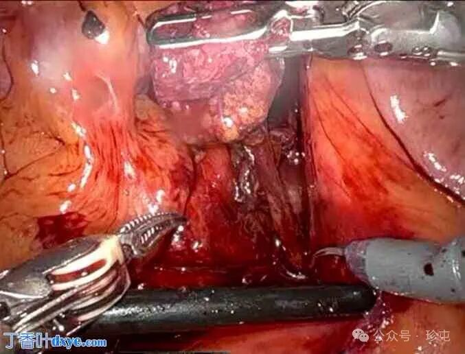 前列腺机器怎么治疗机器人辅助根治性前列腺切除术治疗 Zinner 综合征患者_https://www.jmylbn.com_新闻资讯_第3张