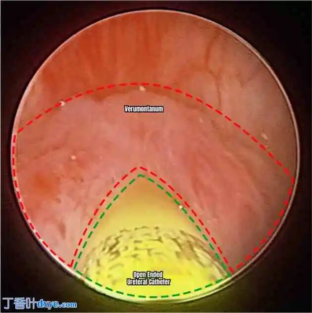 前列腺机器怎么治疗机器人切除大型前列腺囊肿并显微解剖睾丸精子提取术治疗原发性不育症：病例报告_https://www.jmylbn.com_新闻资讯_第2张