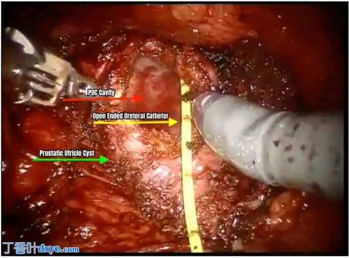 前列腺机器怎么治疗机器人切除大型前列腺囊肿并显微解剖睾丸精子提取术治疗原发性不育症：病例报告_https://www.jmylbn.com_新闻资讯_第4张