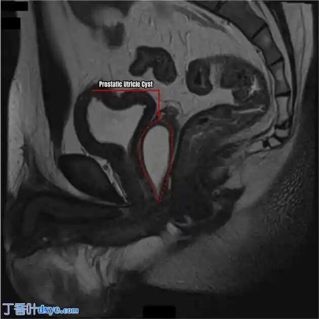 前列腺机器怎么治疗机器人切除大型前列腺囊肿并显微解剖睾丸精子提取术治疗原发性不育症：病例报告_https://www.jmylbn.com_新闻资讯_第1张