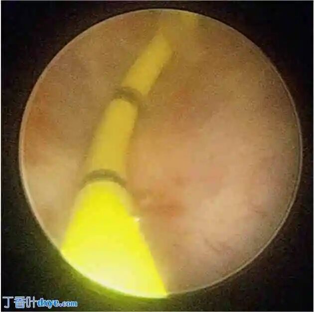 前列腺机器怎么治疗机器人切除大型前列腺囊肿并显微解剖睾丸精子提取术治疗原发性不育症：病例报告_https://www.jmylbn.com_新闻资讯_第3张