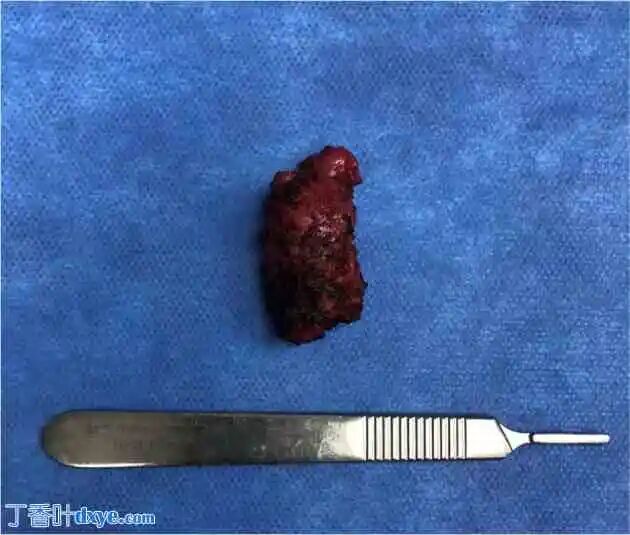 前列腺机器怎么治疗机器人切除大型前列腺囊肿并显微解剖睾丸精子提取术治疗原发性不育症：病例报告_https://www.jmylbn.com_新闻资讯_第5张