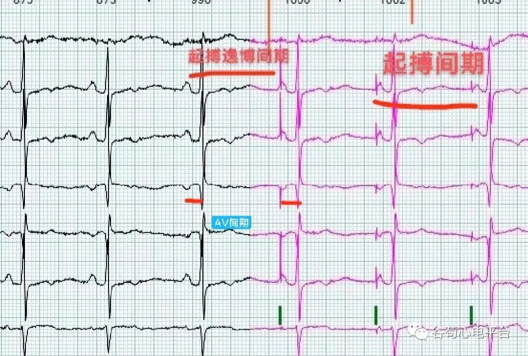 心电图器怎么用国医说图131~134：起搏器“NBG”编码_https://www.jmylbn.com_新闻资讯_第8张
