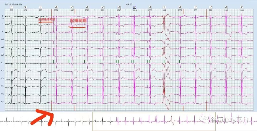 心电图器怎么用国医说图131~134：起搏器“NBG”编码_https://www.jmylbn.com_新闻资讯_第11张