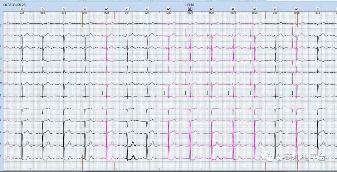 心电图器怎么用国医说图131~134：起搏器“NBG”编码_https://www.jmylbn.com_新闻资讯_第2张