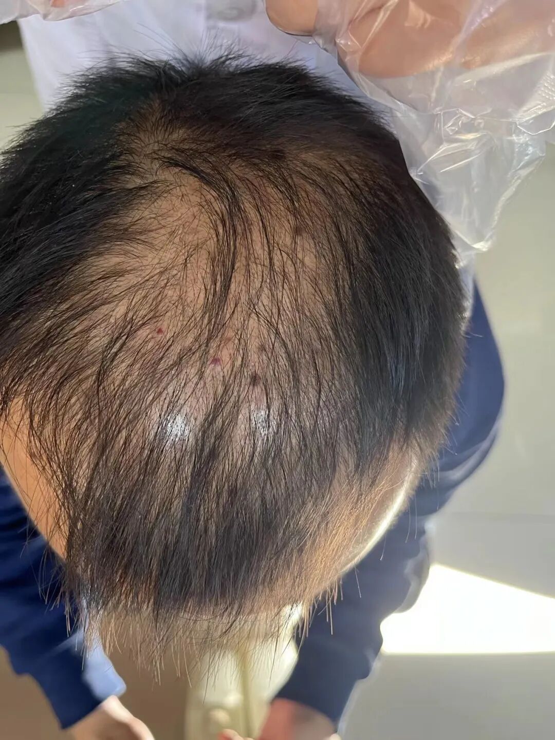 脱发专病门诊，解决您的“头”等大事！