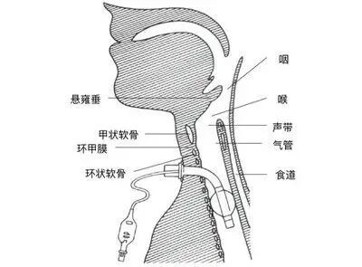 纤支镜什么品牌好一科一技一品牌 ｜ 重症医学科：纤支镜直视下经皮牛角扩张气管切开术_https://www.jmylbn.com_新闻资讯_第17张