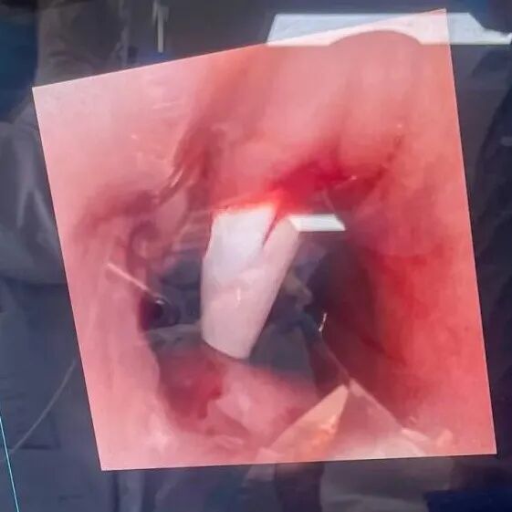 纤支镜什么品牌好一科一技一品牌 ｜ 重症医学科：纤支镜直视下经皮牛角扩张气管切开术_https://www.jmylbn.com_新闻资讯_第14张