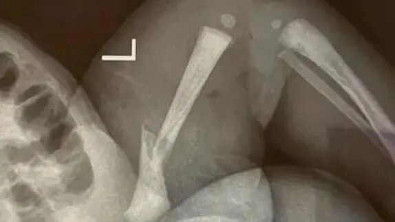 江苏靖江一新生儿骨折16小时后腿部溃烂，家长质疑系医疗事故，院方：手法不熟导致