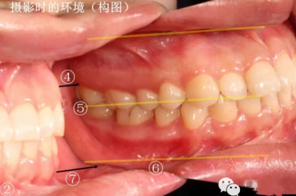 牙医看过来！正畸照片拍摄的正确姿势在这里