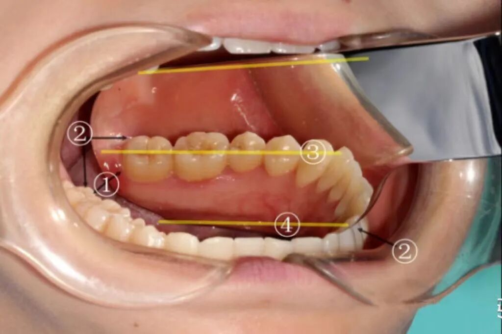 牙医看过来！正畸照片拍摄的正确姿势在这里