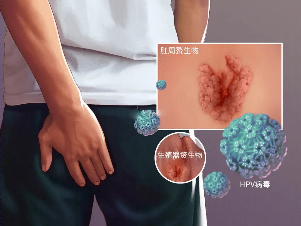 男性hpv感染知多少这些症状你可能要警惕