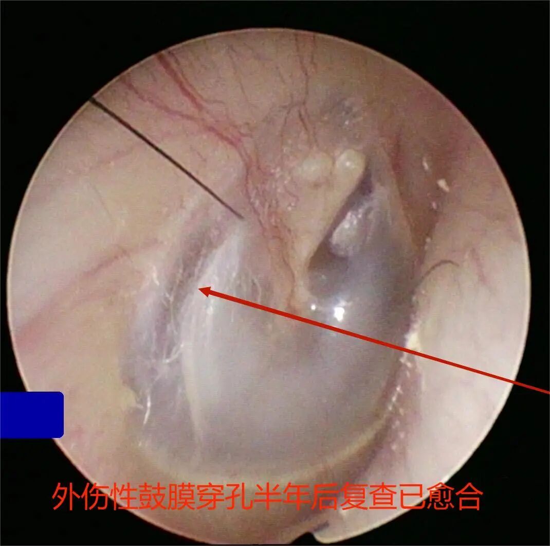 耳鼻喉内窥镜检查是检查什么【健康科普】什么是耳鼻喉内窥镜检查？_https://www.jmylbn.com_新闻资讯_第12张