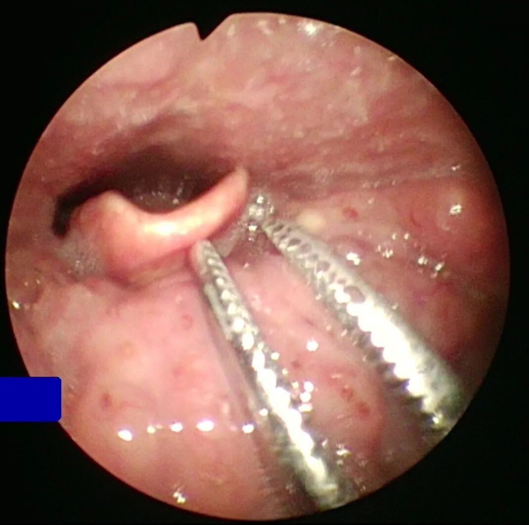 耳鼻喉内窥镜检查是检查什么【健康科普】什么是耳鼻喉内窥镜检查？_https://www.jmylbn.com_新闻资讯_第8张