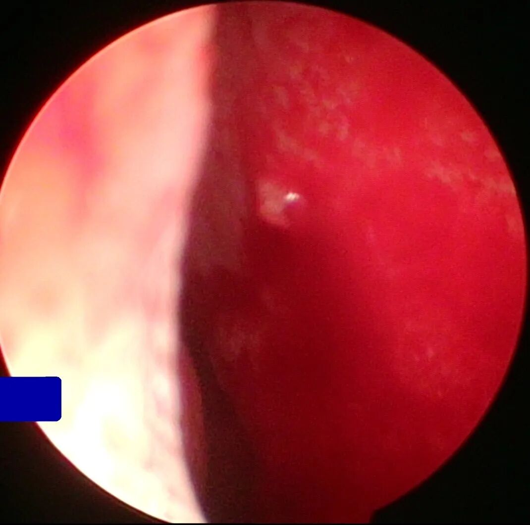 耳鼻喉内窥镜检查是检查什么【健康科普】什么是耳鼻喉内窥镜检查？_https://www.jmylbn.com_新闻资讯_第6张