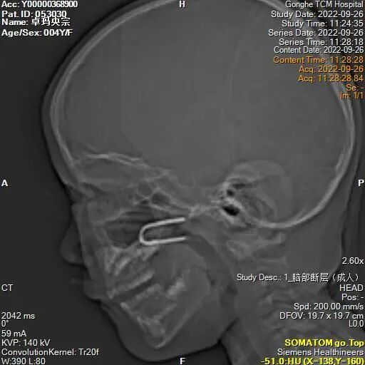耳鼻喉内窥镜检查是检查什么【健康科普】什么是耳鼻喉内窥镜检查？_https://www.jmylbn.com_新闻资讯_第9张