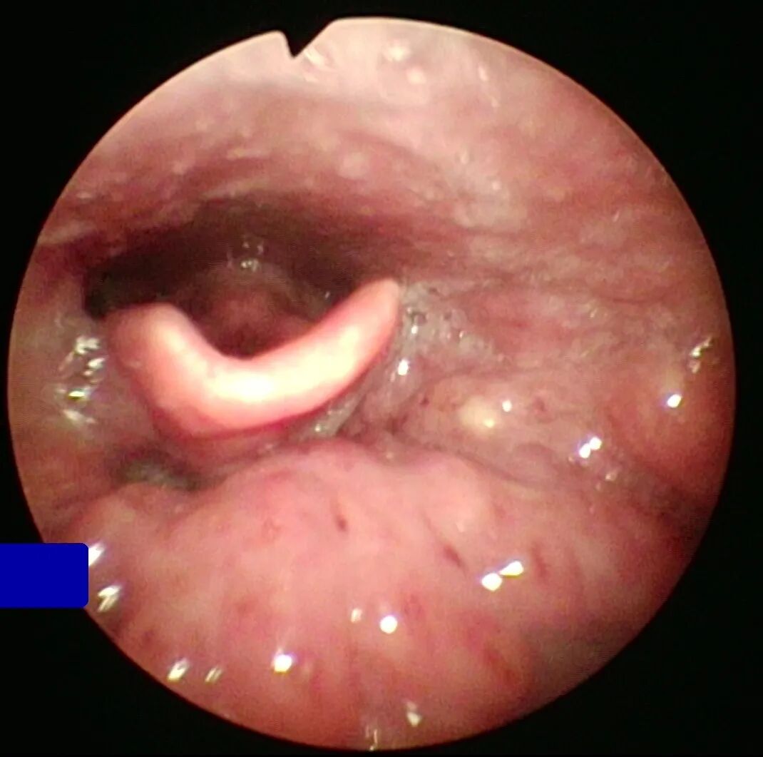 耳鼻喉内窥镜检查是检查什么【健康科普】什么是耳鼻喉内窥镜检查？_https://www.jmylbn.com_新闻资讯_第7张