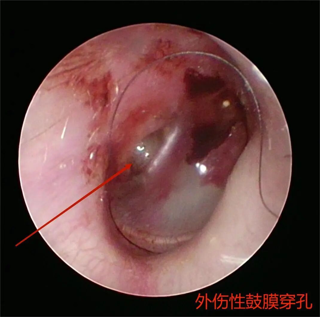 耳鼻喉内窥镜检查是检查什么【健康科普】什么是耳鼻喉内窥镜检查？_https://www.jmylbn.com_新闻资讯_第11张