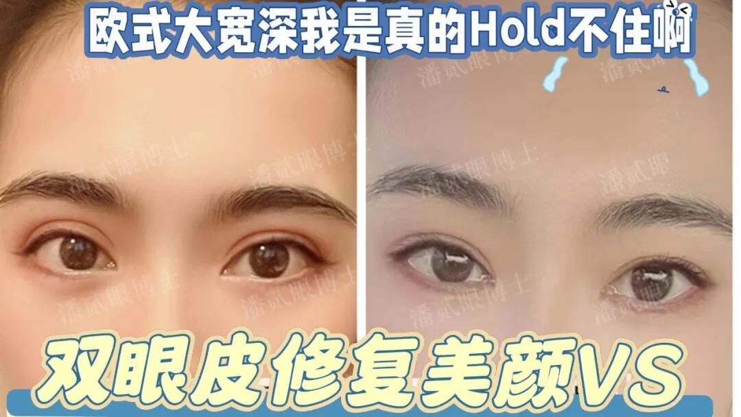 双眼皮修复中为什么会有分期修复？适用于什么情况呢？|潘贰眼博士案例