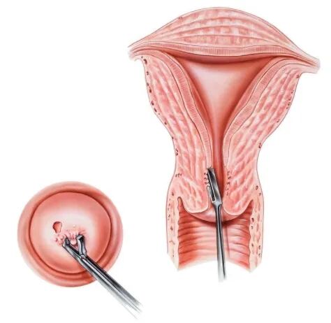 手术损伤部分女性先天性宫颈发育不良,子宫畸形等,可能导致宫口相对