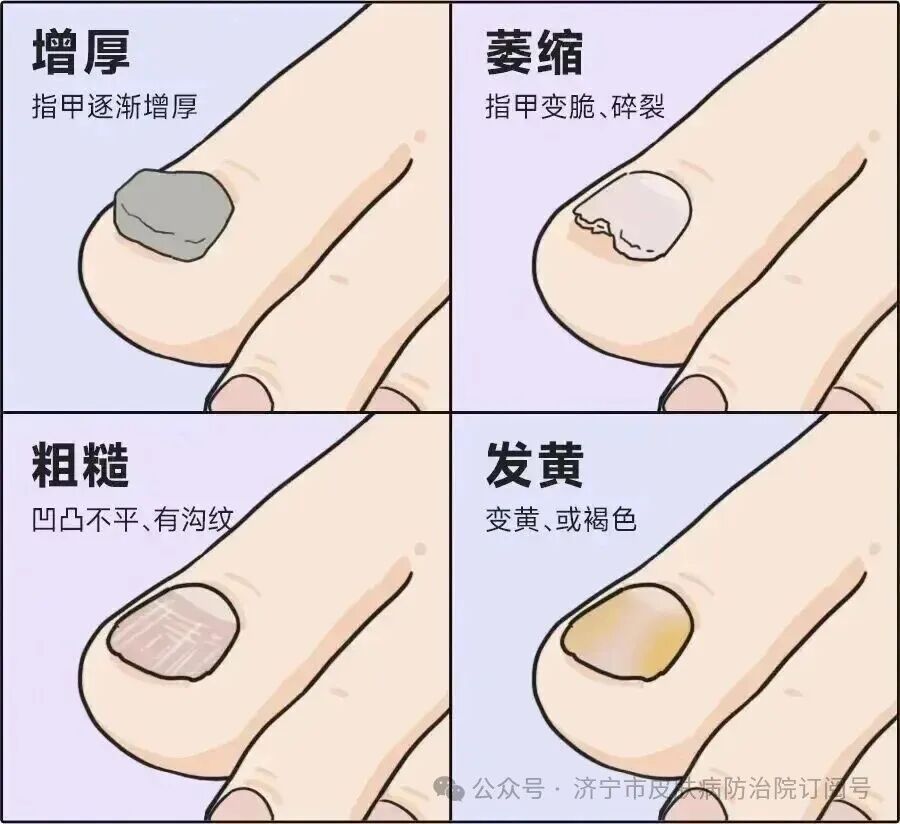 【甲癣专栏第二讲】怎么判断是不是甲癣？别把其他甲病当灰指甲