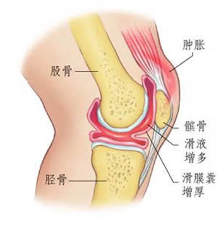 滑膜炎是怎么引起的？滑膜炎的治疗方法有哪些