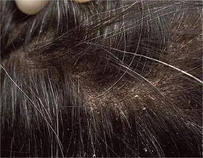 去屑又防脱，酮康唑洗剂真的那么神吗？