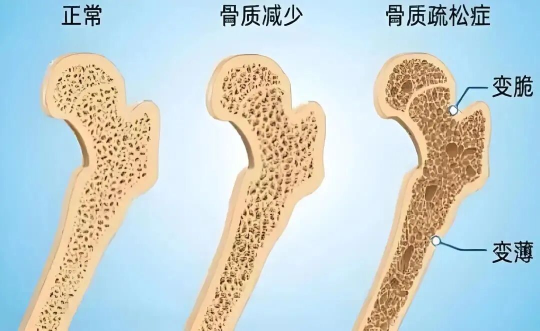 双能x骨密度检测仪为什么非得输入体重身高【再添“利器”】骨质疏松诊断“金标准”——我院引进高端双能X线骨密度仪_https://www.jmylbn.com_新闻资讯_第6张