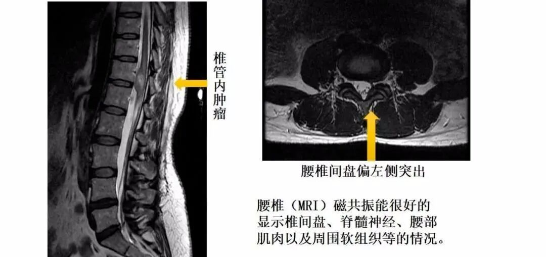 拍胃肠机怎么收费【医学影像科普】腰疼想拍片检查，您拍对了吗？_https://www.jmylbn.com_新闻资讯_第12张