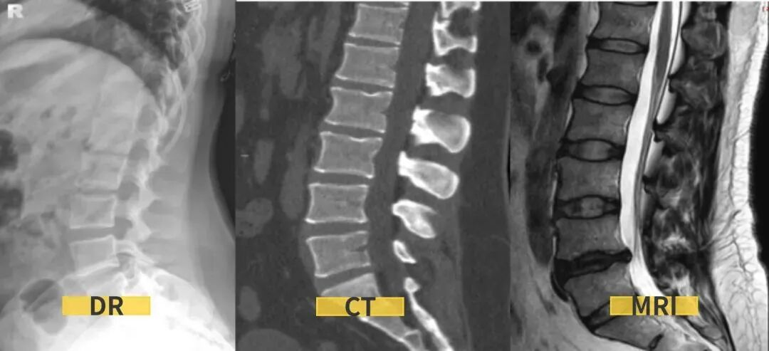 拍胃肠机怎么收费【医学影像科普】腰疼想拍片检查，您拍对了吗？_https://www.jmylbn.com_新闻资讯_第4张