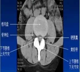 拍胃肠机怎么收费【医学影像科普】腰疼想拍片检查，您拍对了吗？_https://www.jmylbn.com_新闻资讯_第7张
