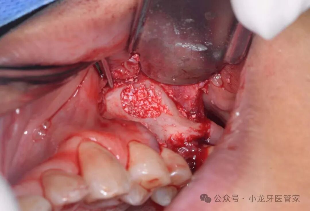 病例分享：上颌窦外提升术一例