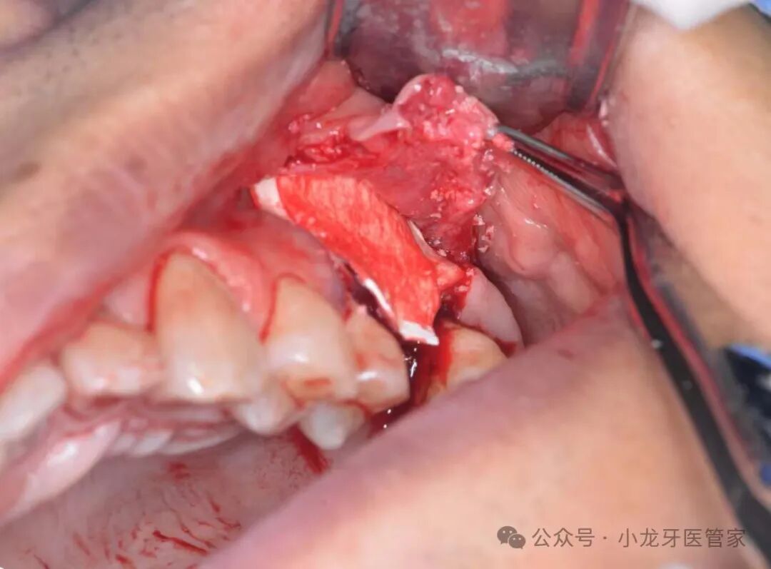 病例分享：上颌窦外提升术一例